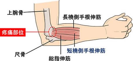 肘の痛みが改善されない原因とは?