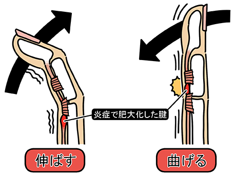 バネ指が改善されない原因とは?